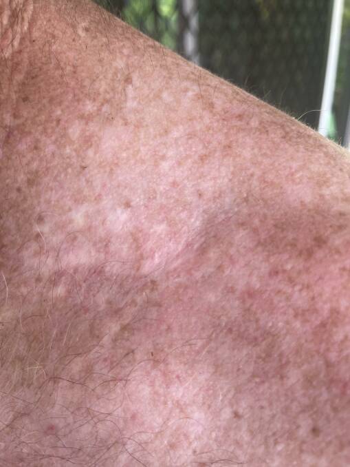 One of Steph Allen's partner Vaughan Browne's melanoma scars. Picture: Steph Allen
